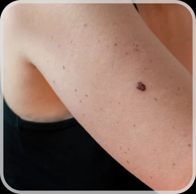 Skin Cancer Management